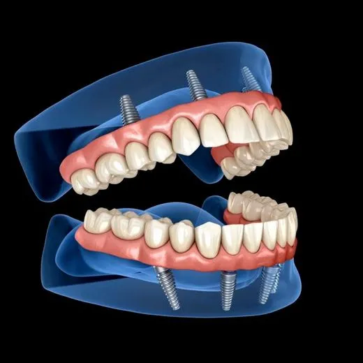 Ilustração de arcada completa sustentada por quatro implantes