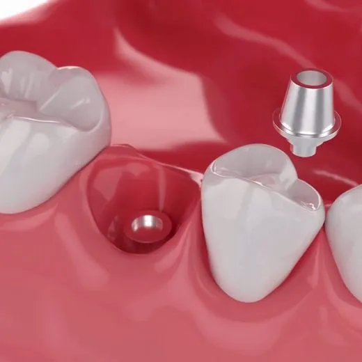Ilustração de implante, pilar e coroa no lugar de um dente