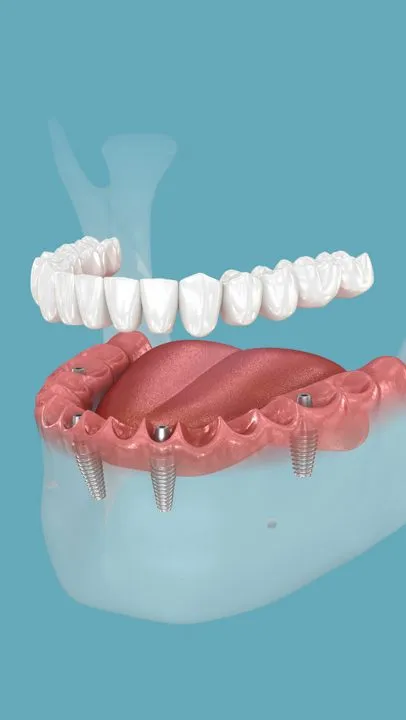 Ilustração de prótese fixa sendo posicionada sobre quatro implantes